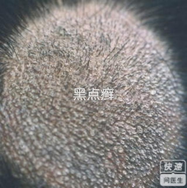 孩子得了头癣怎么办？