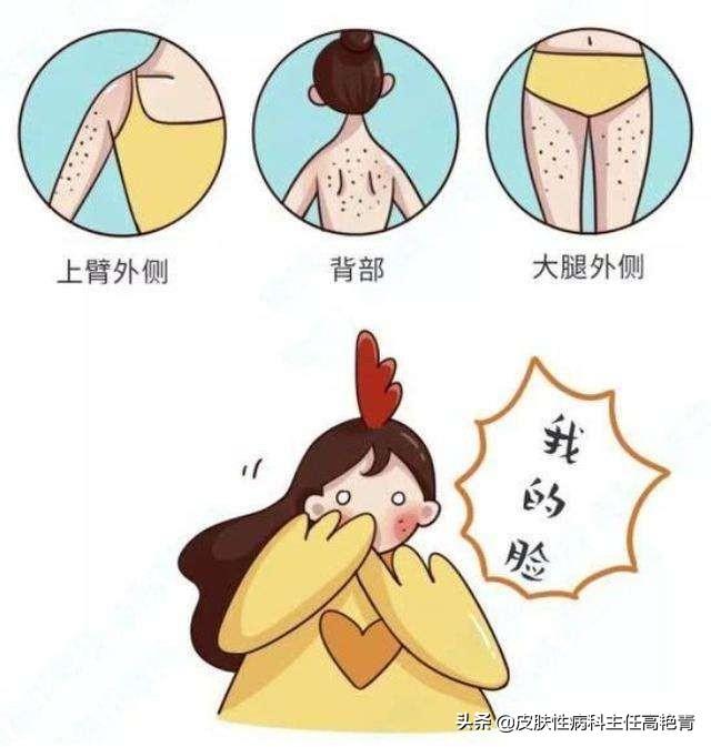 宝宝脸上毛周角化症