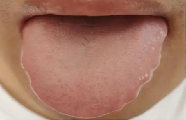 舌头胖大用参苓白术丸没用？胖大舌也分三种，教你如何对症调理