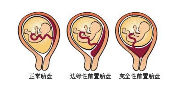 那些孕初期我踩过的“坑”：无敌孕吐，甲状腺激素异常，胎盘前置