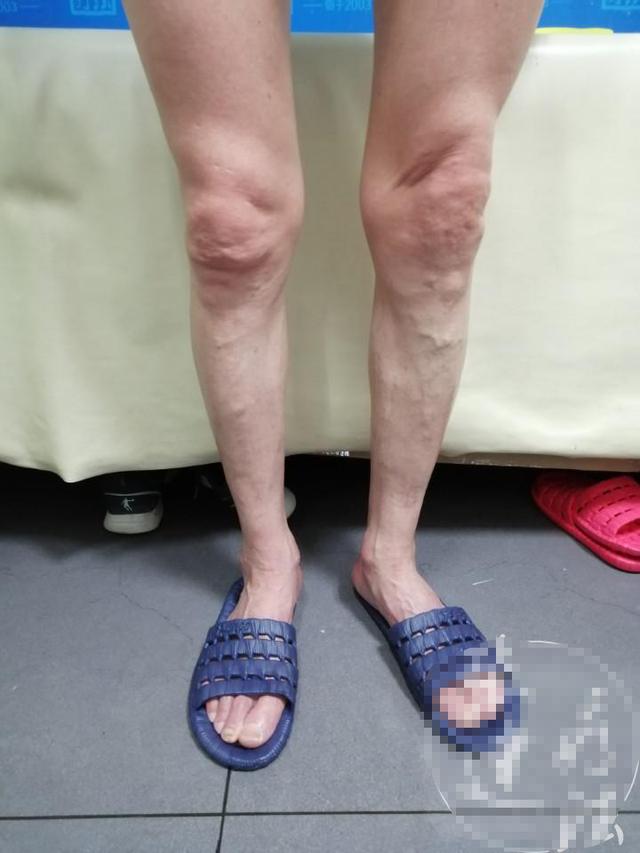 鱼鳞病体毛多缓解