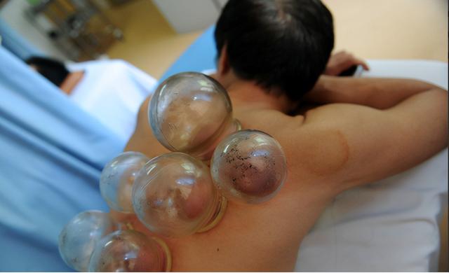 拔火罐时，后背出现的瘀血，是排出的毒素吗？看完涨知识了