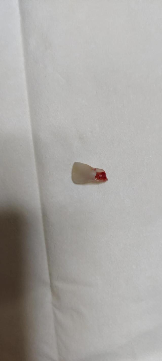 小朋友的牙可以这样拔？