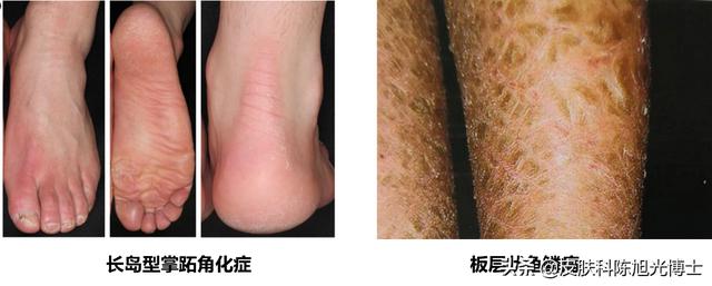 掌趾角化遗传方式