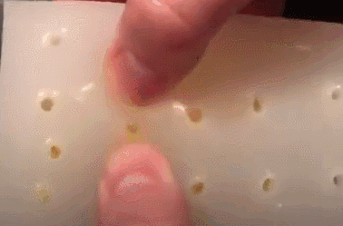 毛囊角化里面挤出来是白色的吗