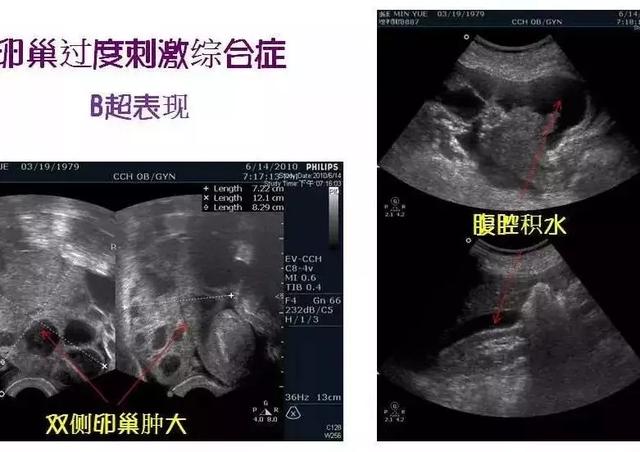 促排取卵时，医生建议的“高蛋白饮食”到底怎么吃？