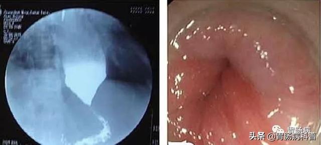 食道癌部分角化