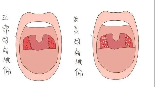 正当换季！请注意化脓性扁桃体发炎