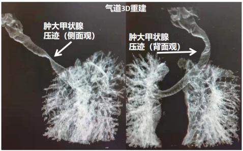 75歲老太太胸悶氣短以為是冠心病，結果卻是甲狀腺腫惹的禍