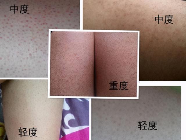 8岁女孩有鸡皮肤