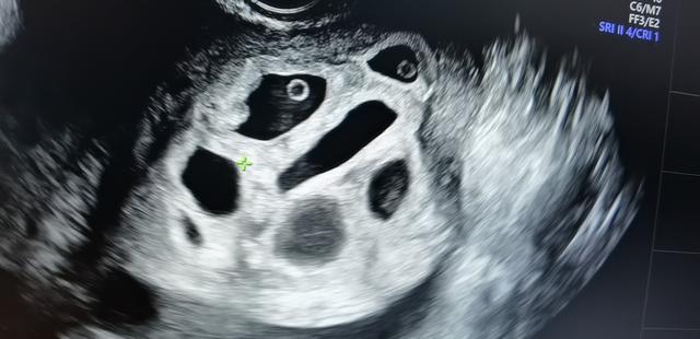 门诊故事——乱用促排药物，怀孕八胞胎