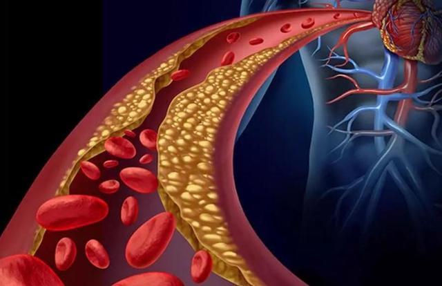 高血脂不能喝牛奶？医生提醒：想降血脂的人，这3种早餐最好远离