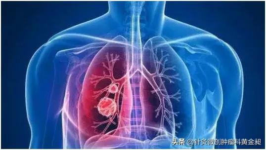 肺癌治疗，要从这五点入手