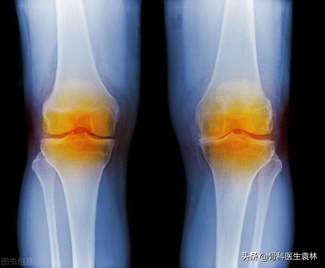 关节炎的早期症状表现有哪些？关节炎早期怎么治疗？