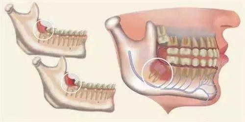 颌骨角化囊肿开过力能再开天窗吗