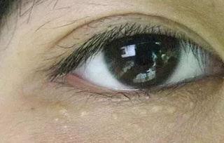 爱长脂肪粒是血脂高吗