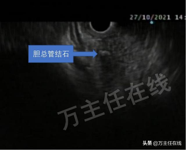 孕34周腹痛入院，多科通力合作挽救胆管结石伴胆管炎妊娠晚期孕妇