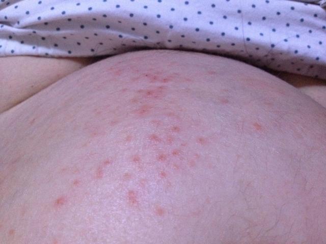 科普 孕妇身上发痒 太阳信息网