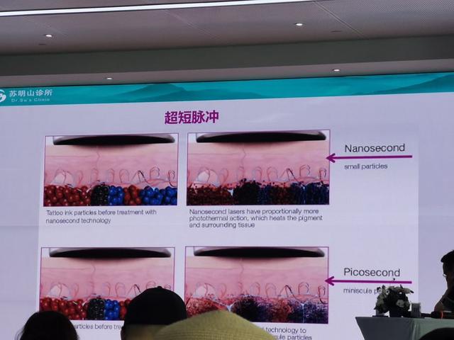 皮秒可以去汗管角化吗