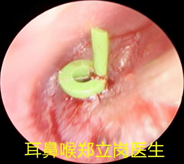 儿童反复发热找不到原因，可能是急性中耳乳突炎