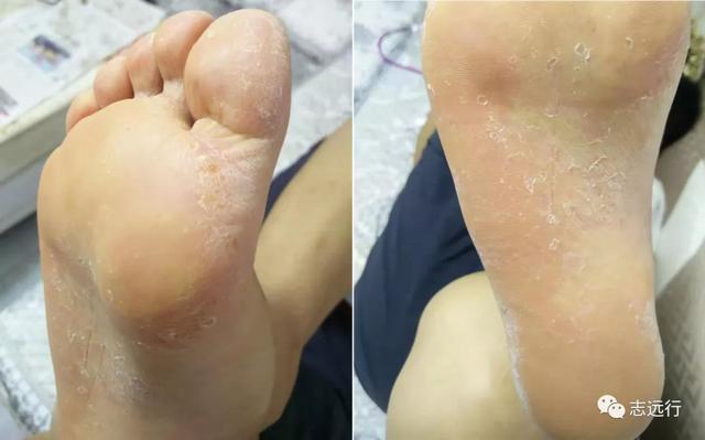 角化形手癣中药熏洗方