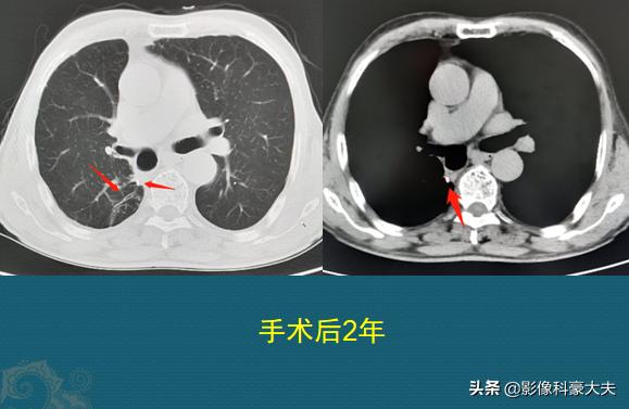 肺癌角化型鳞癌术后化疗