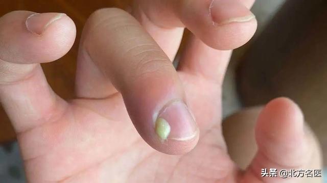 直到一天早上,他发现,自己的指甲周围冒出了白色的脓物,而且疼痛更加