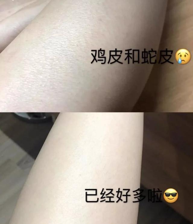 女生冬天腿上为什么会鸡皮肤很痒