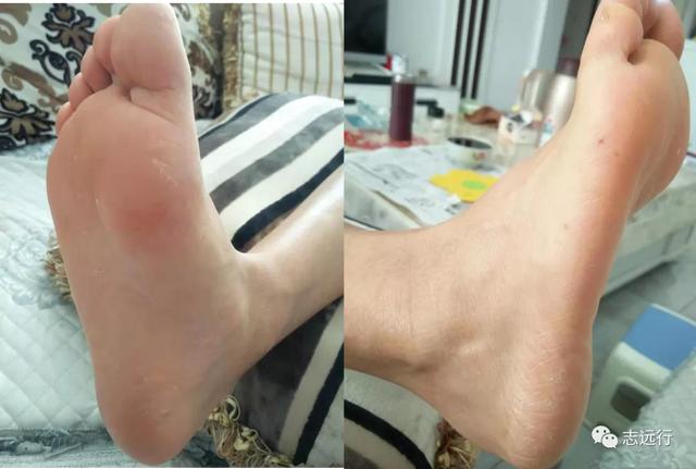 角化形手癣中药熏洗方