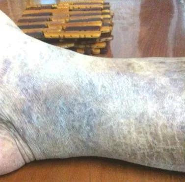 五体痹中脉痹是怎么回事？