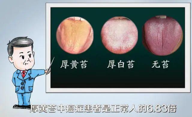 醫生提醒：癌變前，耳朵舌頭會“求救”！厚白苔肺癌，肝癭線肝癌