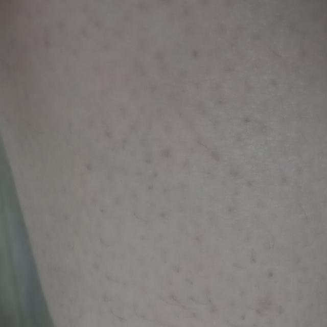 冬天身上干痒有鸡皮肤
