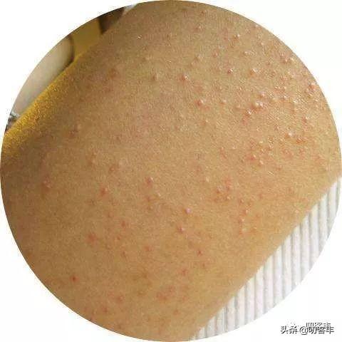 到北方后长鸡皮肤