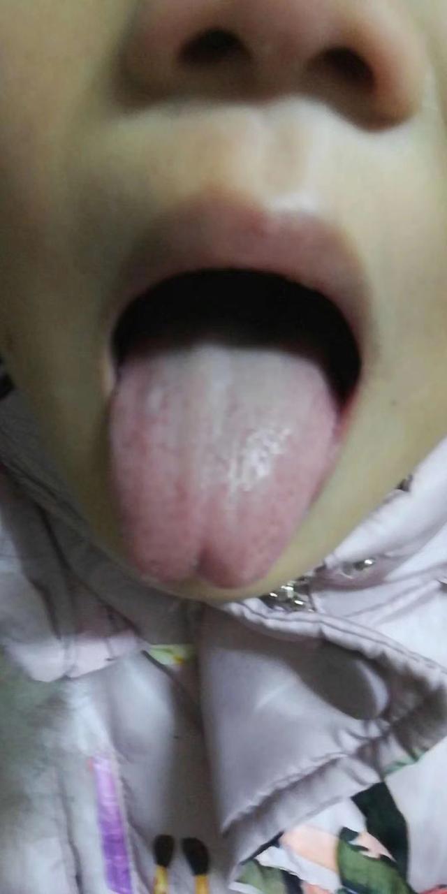 小儿腹痛，警惕肠系膜淋巴结炎