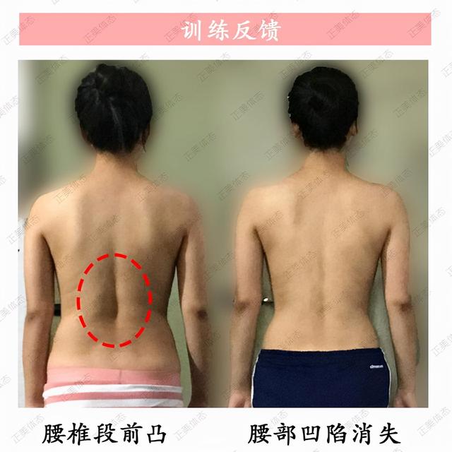 腰后出现大凹陷 你的腰痛可能和 它 有关 今日热点