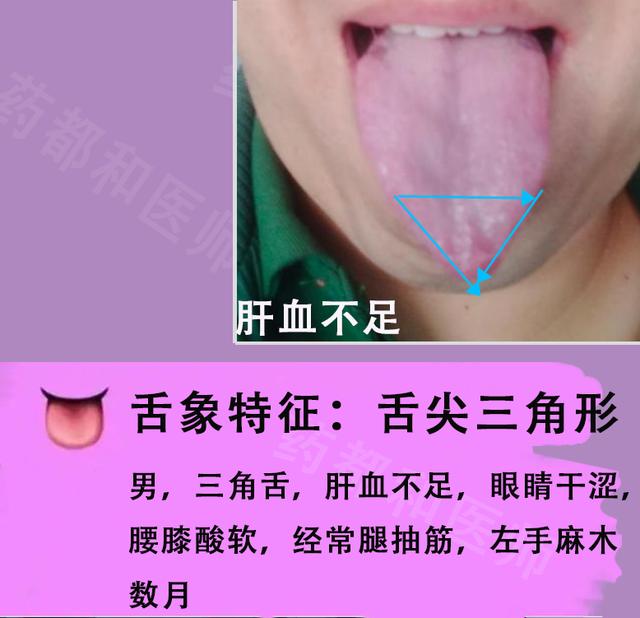 胆囊息肉，胆结石，肝囊肿？6种肝胆病变，看看舌象就知道