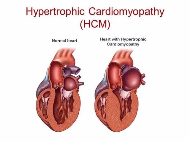 hcm肥厚性心肌病(肥厚性心脏病hcm)(图3)
