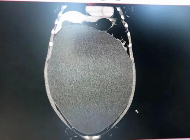 13岁女孩，肚子上全是妊娠纹？放心，这次不是怀孕，但也很危险