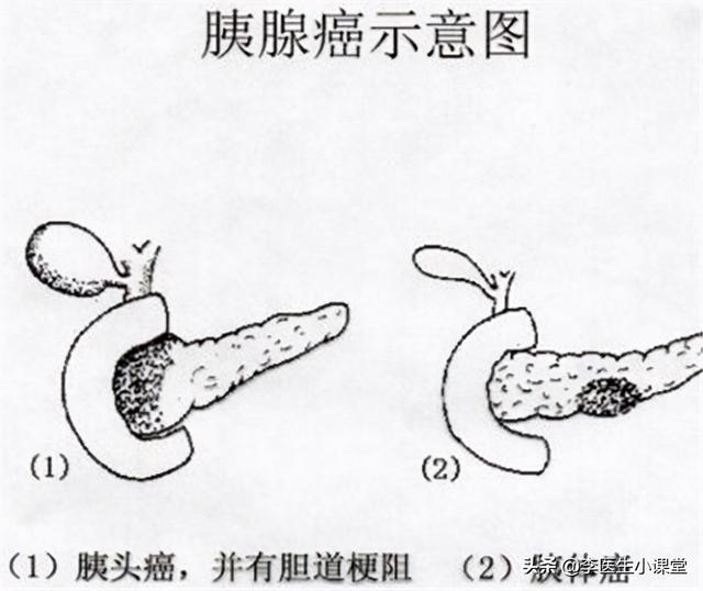 胰腺癌检查薄层核磁是什么意思