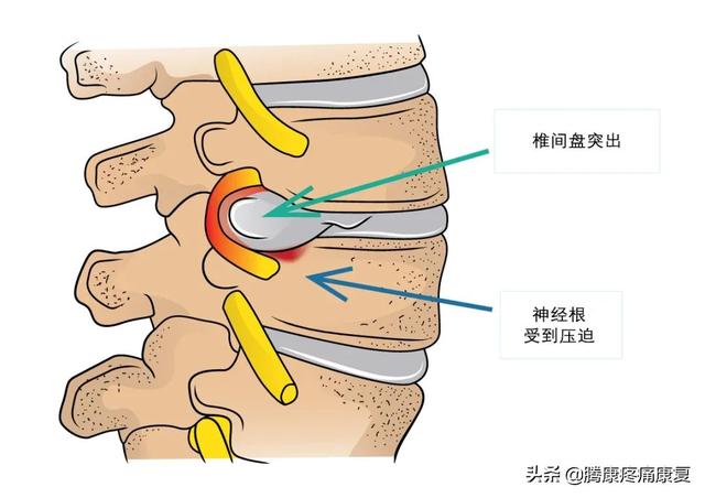 神经根炎