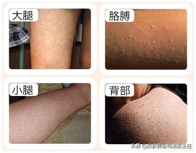 萎缩性红毛发角化症