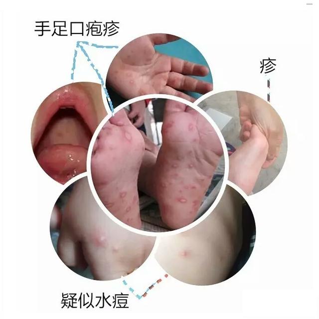 孩子“手脚起皮疹”“嘴里长泡”怎么办？点进来看答案