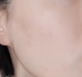 中药调理毛周角化症