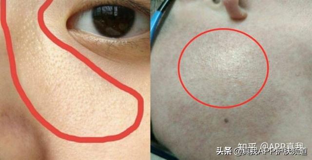 脸上突然出现鸡皮疙瘩