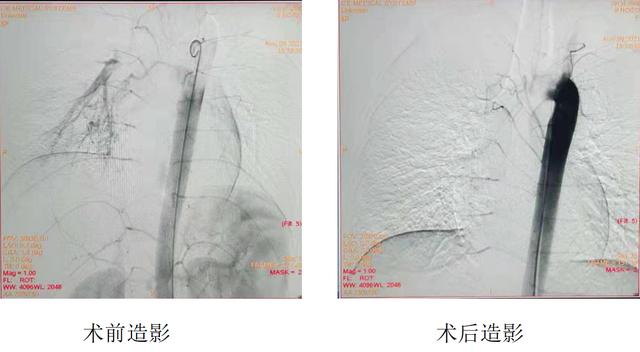 郴州小型单螺旋洗砂机多少钱