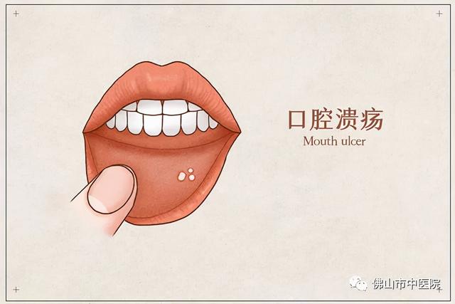 秋燥嘴馋更易口舌生疮专家教你食疗3个小偏方