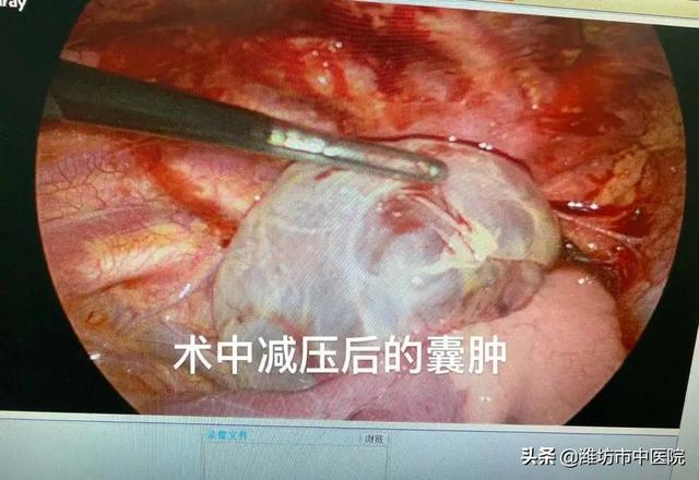 16个月宝宝右肺神秘“消失”