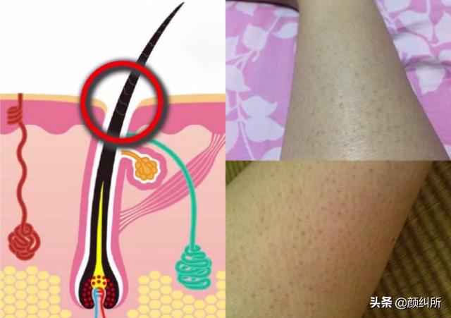 天生鸡皮肤是什么