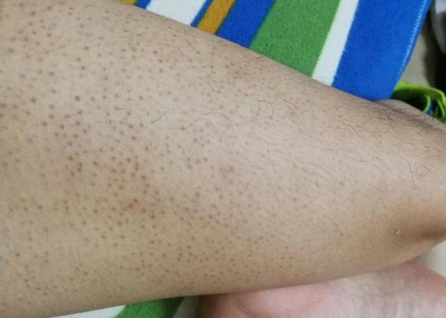 我们说轻微的毛周角化病是不需要治疗的,日常生活中做到以下4点可以