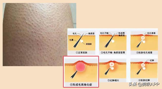 角质鸡皮肤做手术